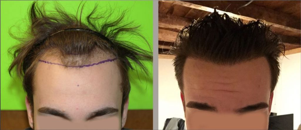 Hair Transplant Before & After Using 2000 Grafts - Dr. Bloxham
