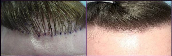Hair Transplant Repair of Old Plugs - Hair Transplant Web Hair Transplant Repair of Old Plugs - Hair Transplant Web