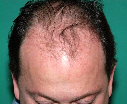 Hair Transplant of Front and Top - Hair Transplant Web