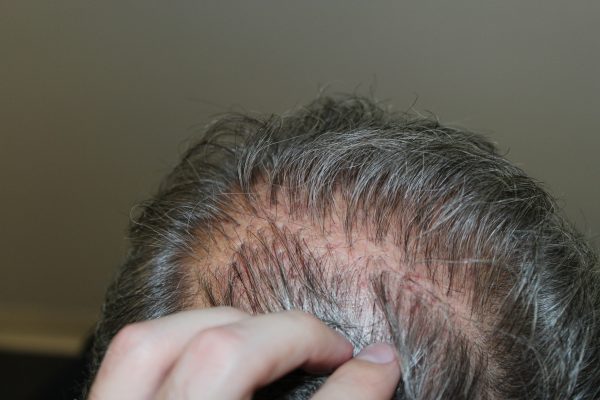 Hair Transplant Plugs, Learn About Hair Plug Surgery Treatment