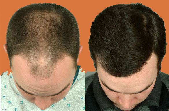 Finding the Top Hair Transplant Doctors in Tulsa, OK - DrKent Webb, MD,  FACS