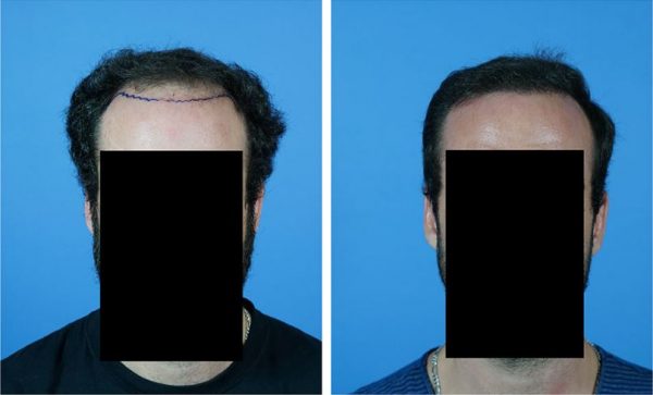 Hair Loss and Identity theft - Hair Transplant Web