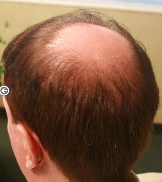 Bald Spot Hair Transplant - Hair Transplant Web