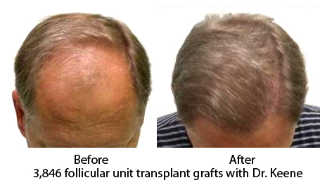 Hair Restoration Gallery  Before After Hair Transplant Photos  Dr Bonaros