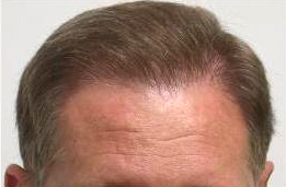 after hair transplant dr keene Az