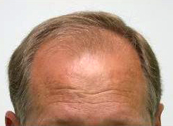 hair transplant before